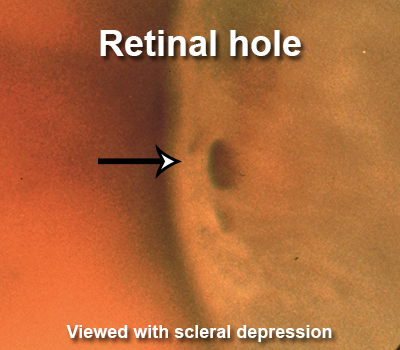 retinalhole