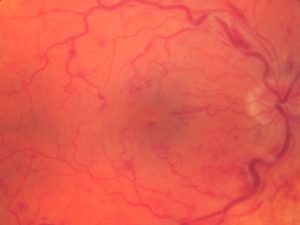 The Importance of Early Detection for Retinal Vein Occlusion and Macular Edema