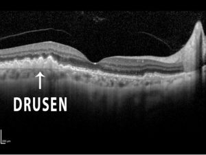 Dry Macular Degeneration - Retina Vitreous Associates of Florida Dry Macular Degeneration