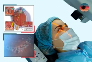 What to Expect After Laser Surgery for a Retinal Tear: Recovery, Risks & Tips