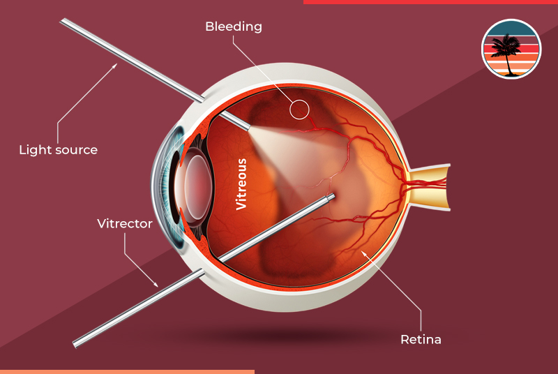 What Not To Do After a Vitrectomy: Explained Instruction