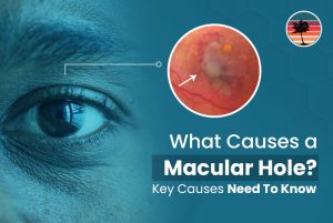 What Causes a Macular Hole? Key Causes Need To Know