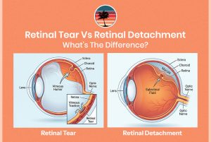 Retinal Tear Vs Retinal Detachment: What’s The Difference?