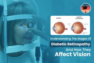 Understanding The Stages Of Diabetic Retinopathy And How They Affect Vision
