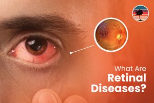 What Are Retinal Diseases?